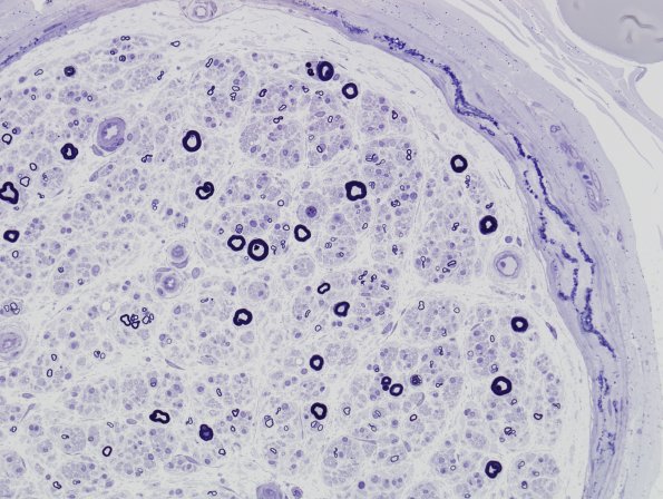 10A2 Perineurial calcifications (Case 10) Plastic 2