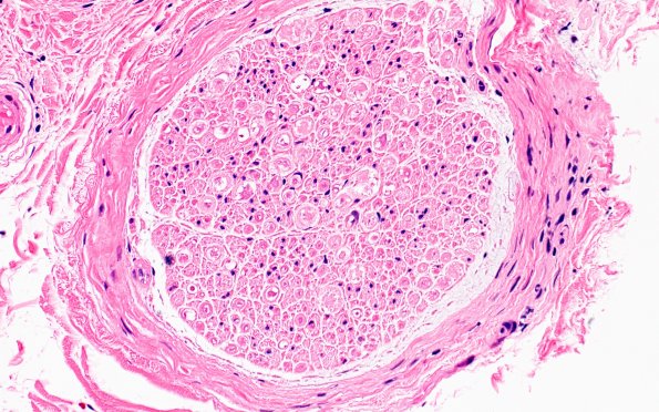 11A3 Perineuritis & Vasculopathy (Case 11 H&E 40X 2