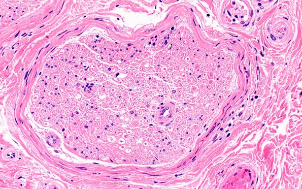 11A4 Perineuritis & Vasculopathy (Case 11) H&E 40X