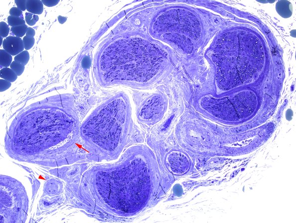 11C1 Perineuritis & Vasculopathy (Case 11) Plastic 10X copy.jpg