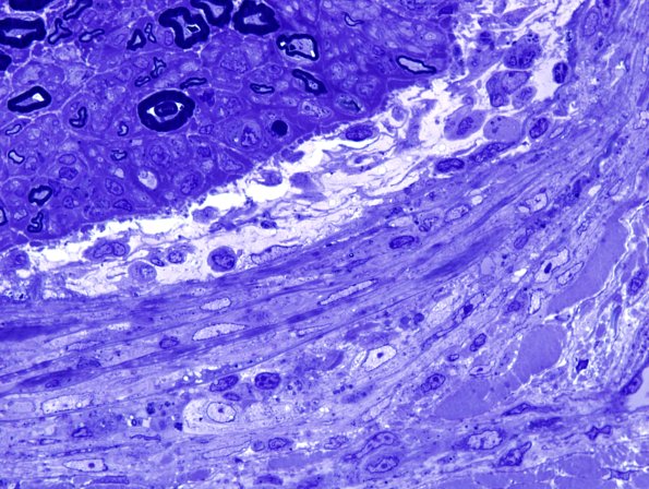 11C5 Perineuritis & Vasculopathy (Case 11) Plastic 5.jpg