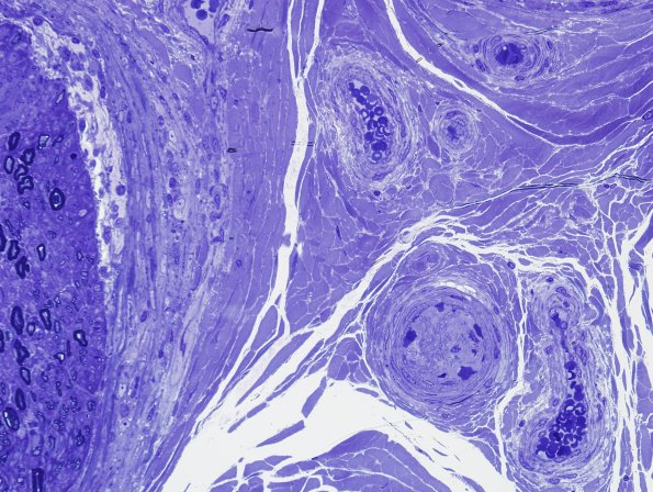 11C6 Perineuritis & Vasculopathy (Case 11) Plastic 1.jpg