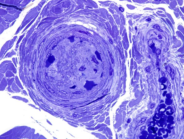 11C7 Perineuritis & Vasculopathy (Case 11) Plastic 3.jpg