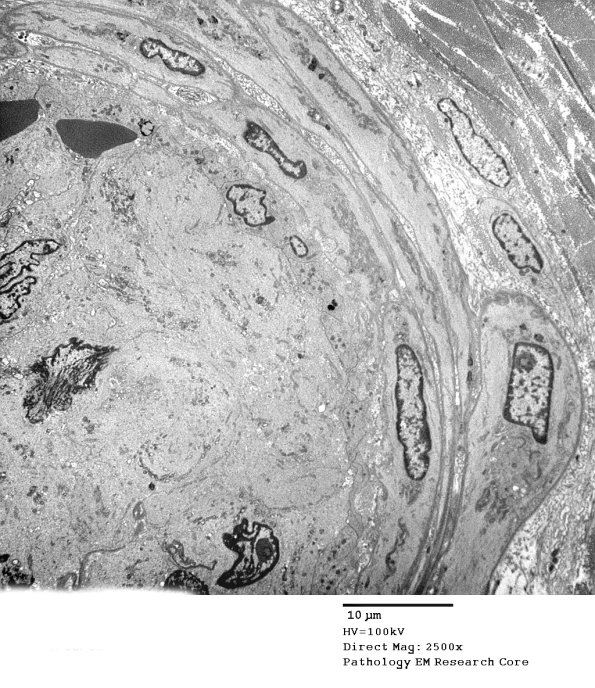 11C7A (Case 11) Nerve_004 - Copy