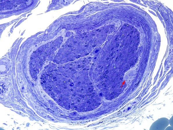 11C8 Perineuritis & Vasculopathy (Case 11) Plastic 10 copy.jpg