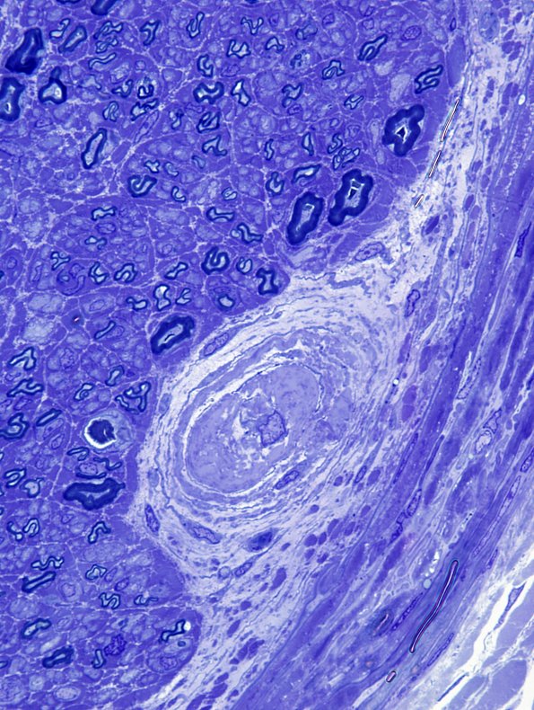 11C9 Perineuritis & Vasculopathy (Case 11) Plastic 13.jpg