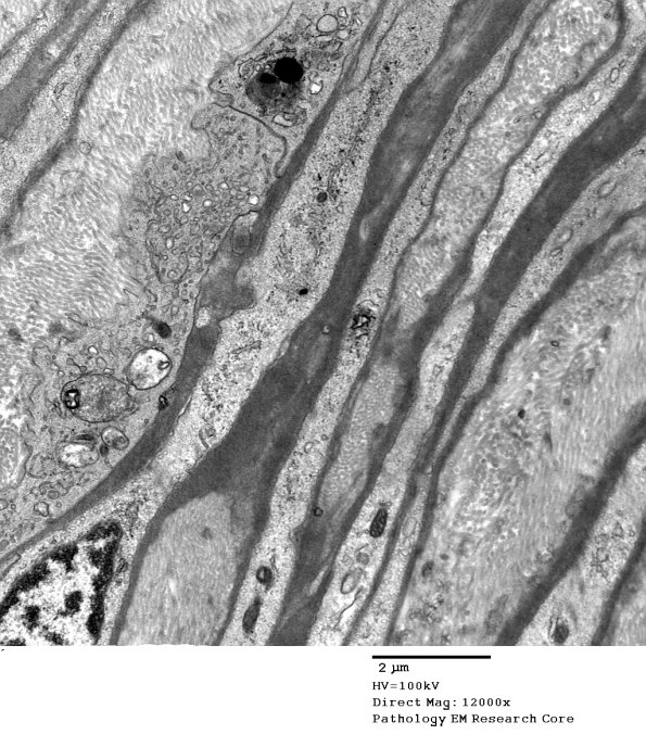 11D1 Perineurium, (Case 11) EM 018 - Copy