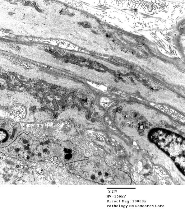 11D2 (Case 11) Nerve_012 - Copy