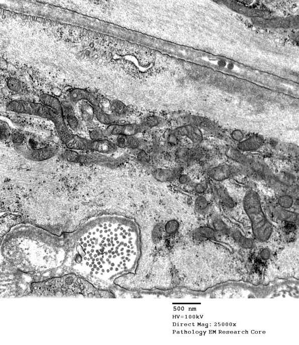 11D3 (Case 11) Nerve_013 - Copy