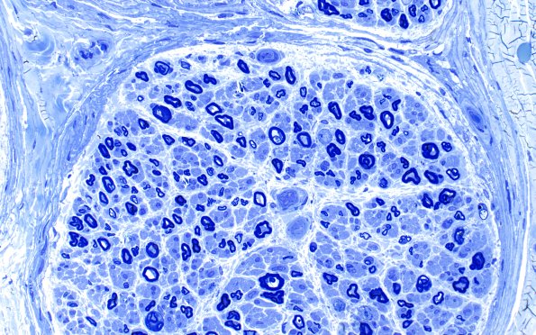 12A1 Perineurium, papillary basal lamina (Case 12) Plastic 40X