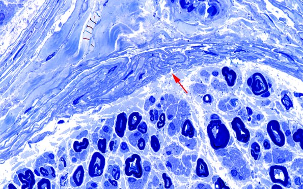 12A2 Perineurium, papillary basal lamina (Case 12) Plastic 100X 3 copy