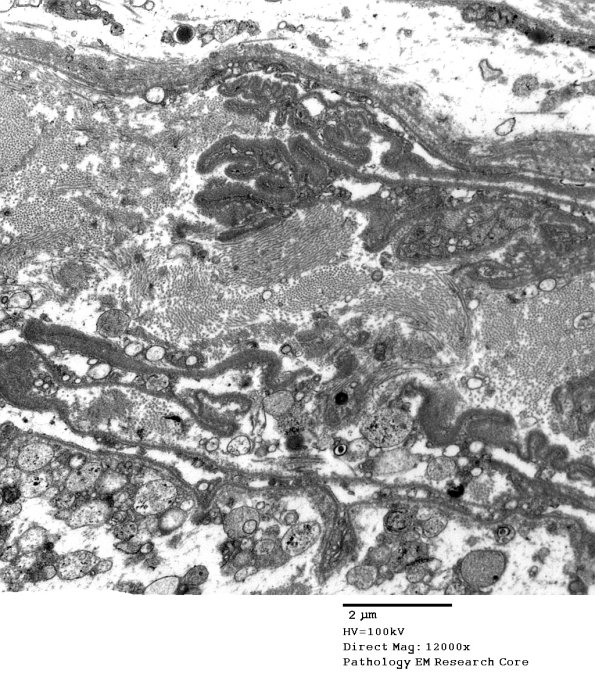 12B1 Perineurium, papillary basal lamina (Case 12) EM 041 - Copy