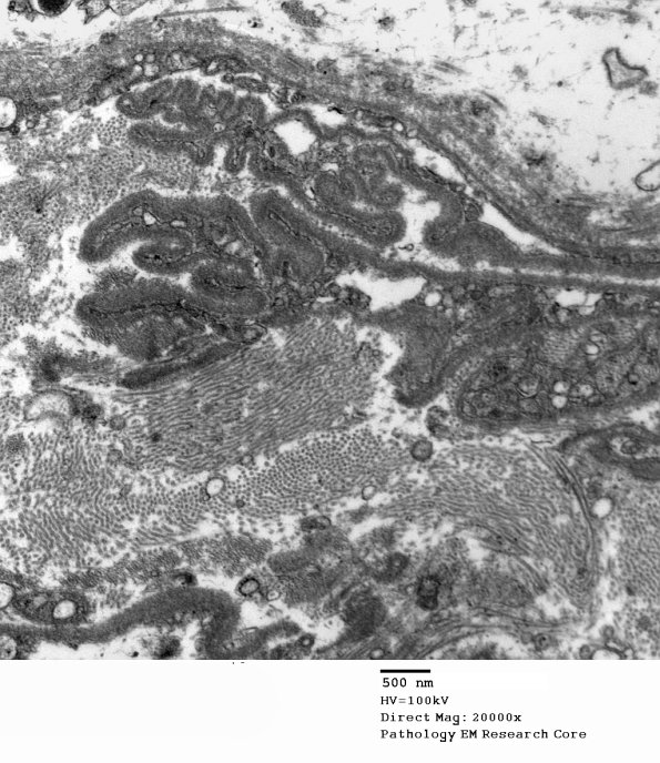 12B2 Perineurium, papillary basal lamina (Case 12) EM 037 - Copy