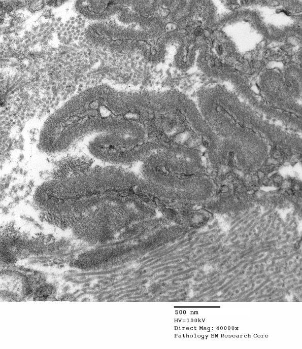 12B3 Perineurium, papillary basal lamina (Case 12) EM 038 - Copy