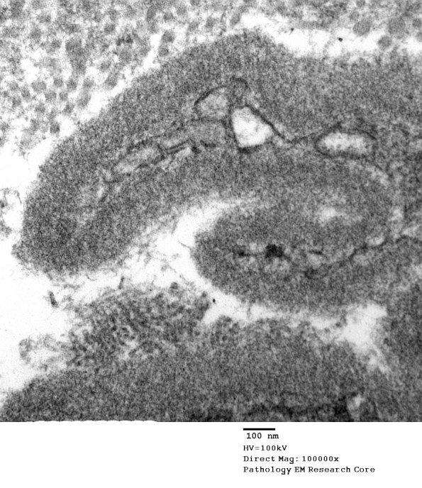 12B4 Perineurium, papillary basal lamina (Case 12) EM 040 - Copy