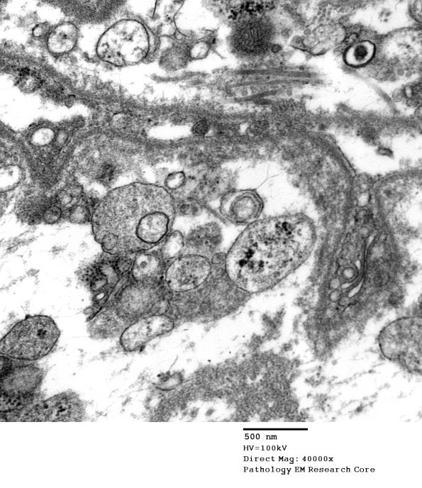 12B5 Perineurium, organelles (Case 12) EM 047 - Copy