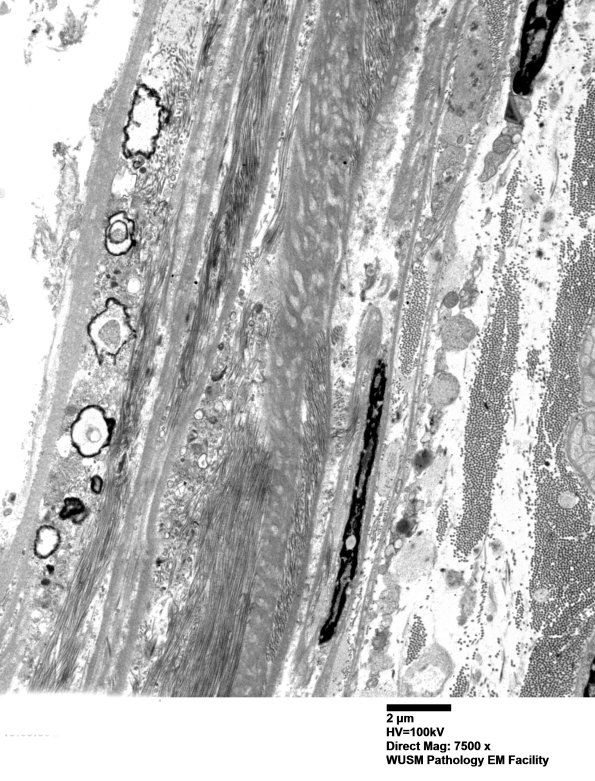 13A1 (Case 13) Nerve_001 - Copy