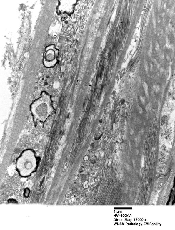 13A2 (Case 13) Nerve_002 - Copy