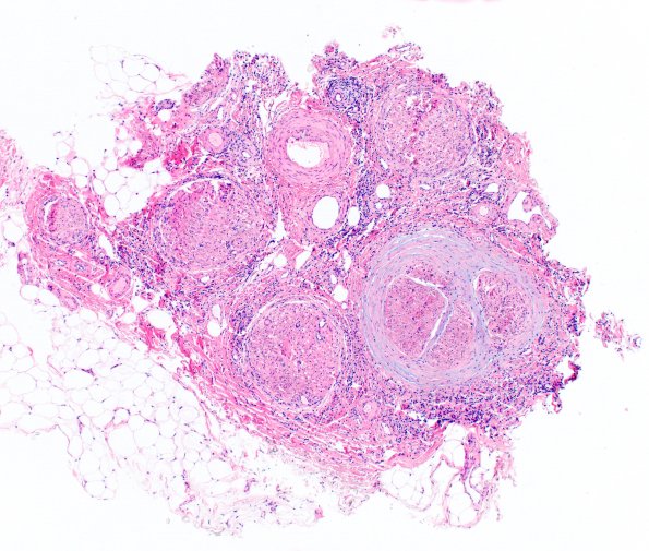 1A1 Epineuritis & Perineuritis (Case 1) Immune checkpoint 4XA