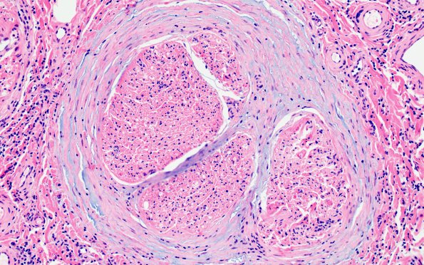 1A3 Epineuritis & Perineuritis (Case 1) Immune checkpoint 20X 6