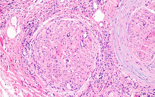 1A4 Epineuritis & Perineuritis (Case 1) Immune checkpoint 20X 2