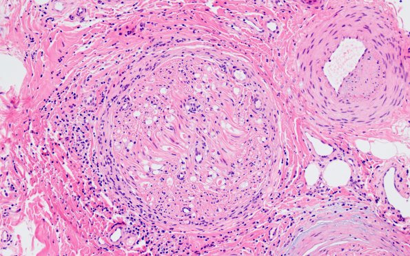 1A5 Epineuritis & Perineuritis (Case 1) Immune checkpoint 20X