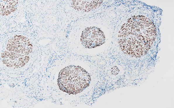 1B1 Epineuritis & Perineuritis (Case 1) Immune checkpoint NF 10X