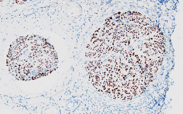 1B2 Epineuritis & Perineuritis (Case 1) Immune checkpoint NF 10X 2