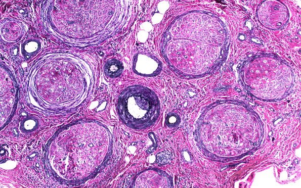 1C1 Epineuritis & Perineuritis (Case 1) Immune checkpoint VVG 1B