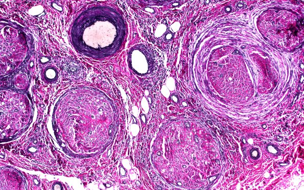1C2 Epineuritis & Perineuritis (Case 1) Immune checkpoint VVG 10X 2