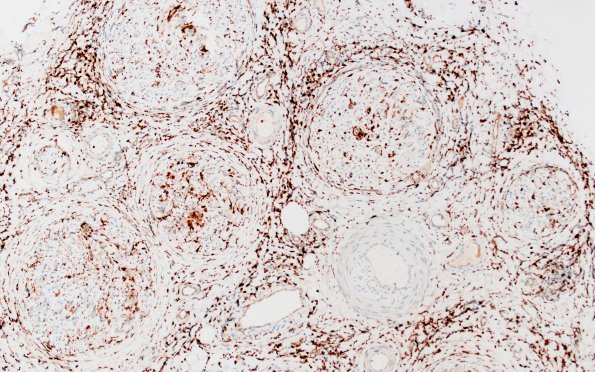 1D1 Epineuritis & Perineuritis (Case 1) Immune checkpoint CD68 10X