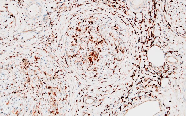 1D2 Epineuritis & Perineuritis (Case 1) Immune checkpoint CD68 20X
