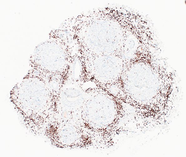 1E1 Epineuritis & Perineuritis (Case 1) Immune checkpoint CD3 4X