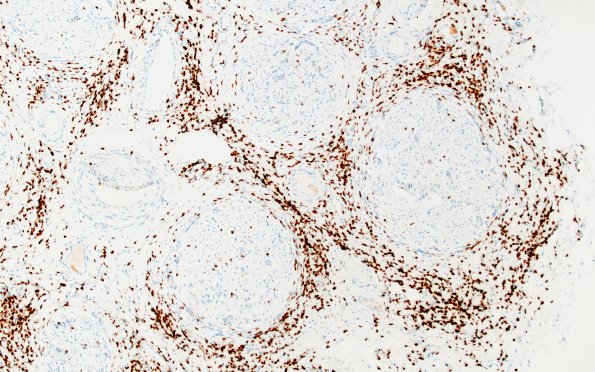 1E2 Epineuritis & Perineuritis (Case 1) Immune checkpoint CD3 10X