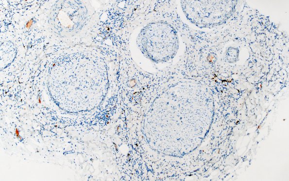 1F1 Epineuritis & Perineuritis (Case 1) Immune checkpoint CD20 10X 2