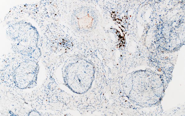 1F2 Epineuritis & Perineuritis (Case 1) Immune checkpoint CD20 10X