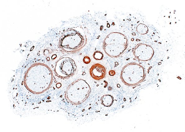 1G1 Epineuritis & Perineuritis (Case 1) Immune checkpoint SMA 4X