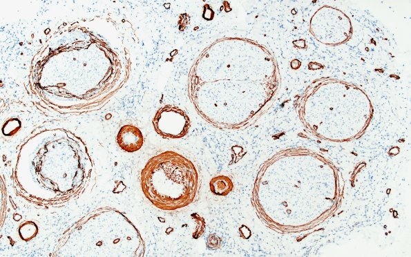 1G2 Epineuritis & Perineuritis (Case 1) Immune checkpoint SMA 10X