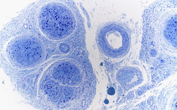 1H2 Epineuritis & Perineuritis (Case 1) Immune checkpoint Plastic 10X