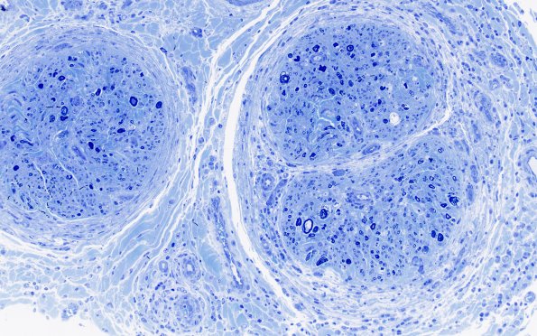 1H4 Epineuritis & Perineuritis (Case 1) Immune checkpoint Plastic 20X 3