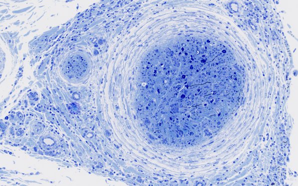 1H5 Epineuritis & Perineuritis (Case 1) Immune checkpoint Plastic 20X 4