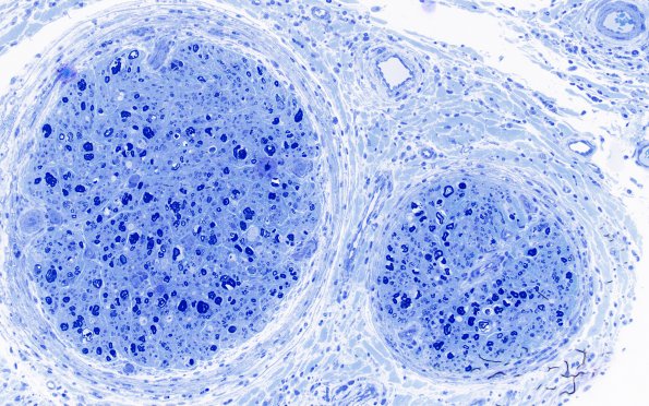1H6 Epineuritis & Perineuritis (Case 1) Immune checkpoint Plastic 20X 5
