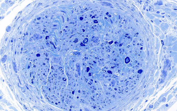 1H8 Epineuritis & Perineuritis (Case 1) Immune checkpoint Plastic 40X