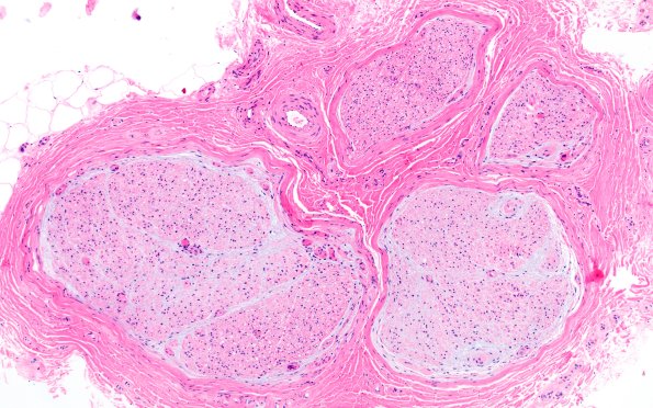 2A1 Perineuritis, focal (Case 2) H&E 1