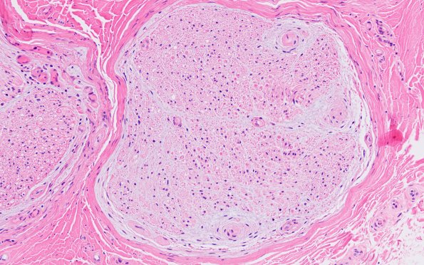 2A2 Perineuritis, focal (Case 2) H&E 2A