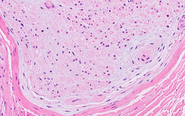 2A3 Perineuritis, focal (Case 2) H&E 5A