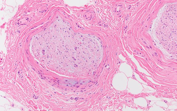 2A4 Perineuritis, focal (Case 2) H&E 6