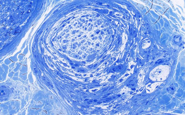 2B2 Perineuritis, focal (Case 2) Plastic 3A