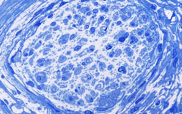 2B3 Perineuritis, focal (Case 2) Plastic 10A