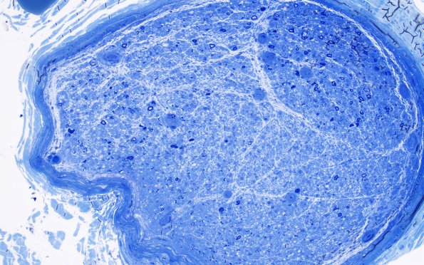 2B4 Perineuritis, focal (Case 2) Plastic 4A